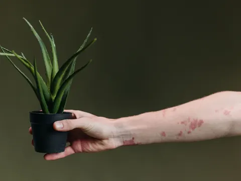 An arm with red patches of eczema