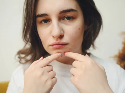 A young woman pointing at a spot on her chin