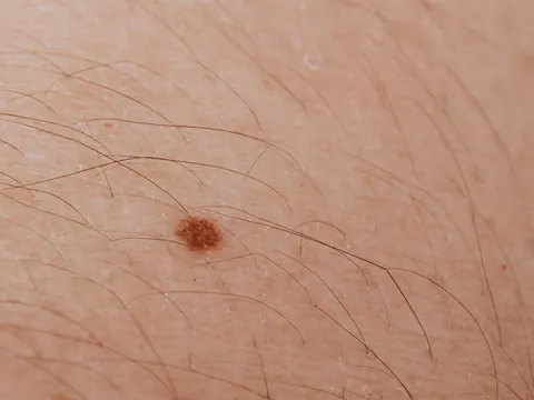 A mole on the skin, close up